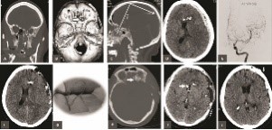 Mugshots indicating the mechanism of pTBI in a 36-y-o lady who attempted suicide by a submental GSWH.